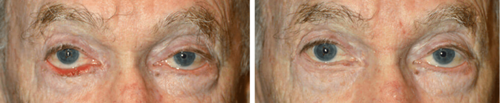 ectropion de paupières avant et après chirurgie par le docteur Bordereau