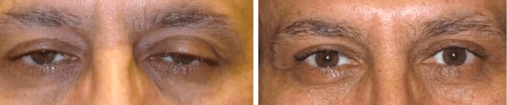 chirurgie de ptosis avant et après chirurgie par le docteur Bordereau à Nantes