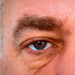 poche sous les yeux avant chirurgie de blépharoplastie inférieure par le docteur bordereau à Nantes
